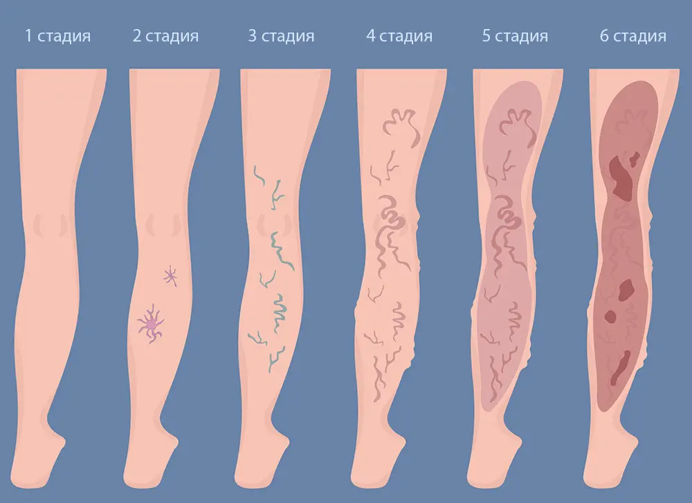Стадії варикозу
