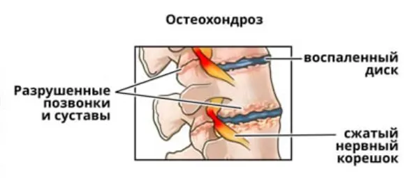 Лікування міжхребцевої грижі