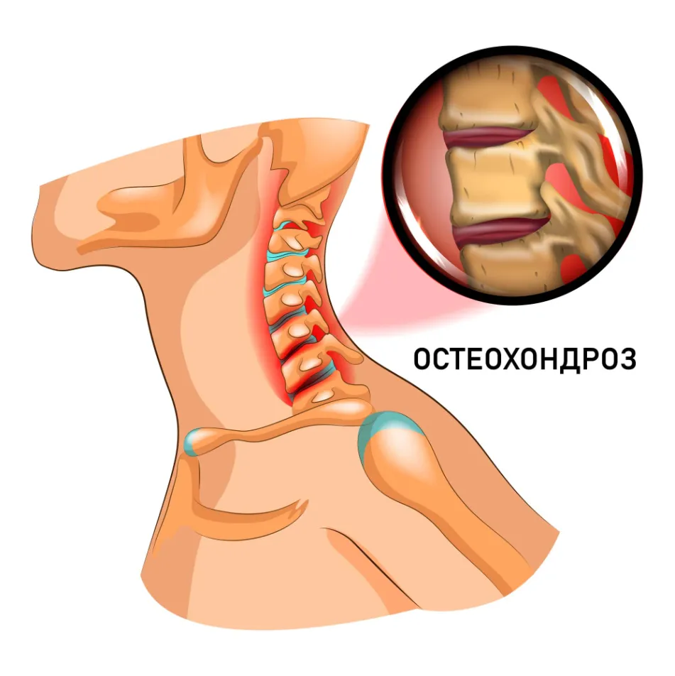 Остеохондроз: можно ли остановить развитие заболевания?