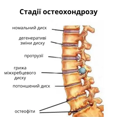 Стадії остеохондрозу